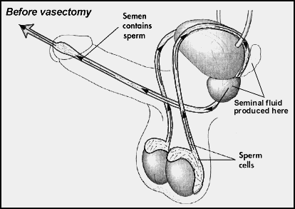 Vasectomy – MPHC